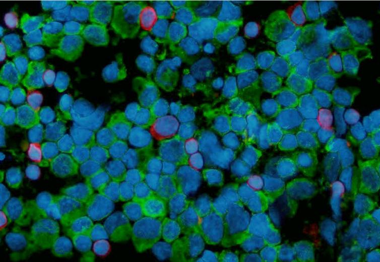 右と同一症例で実施した特殊染色。B細胞型のリンパ腫と診断された（遺伝子検査も同じ結果）。 青色：核、緑色：B細胞（CD79α）、 赤色：T細胞（CD3）。