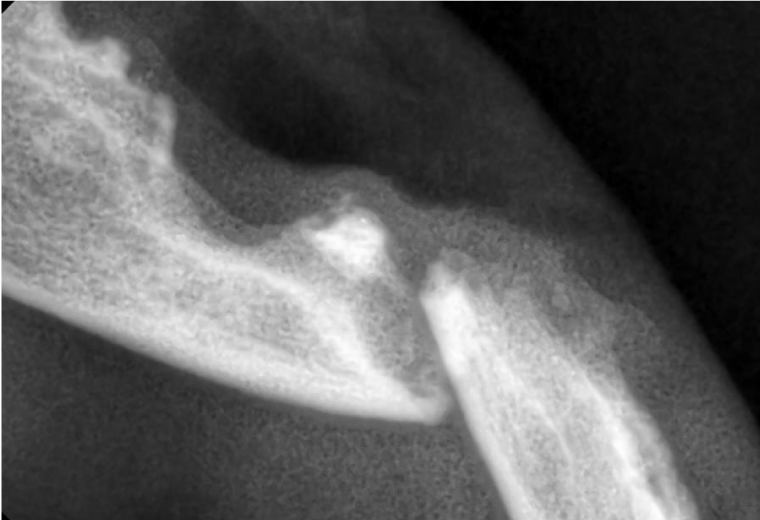 Figure 4: X-ray of mandibular fracture