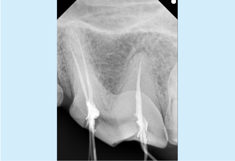 Figure 10: Digital dental X-ray of filling