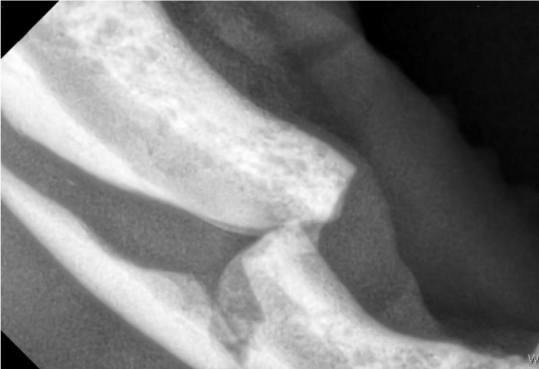 Figure 14: X-ray of mandibular fracture
