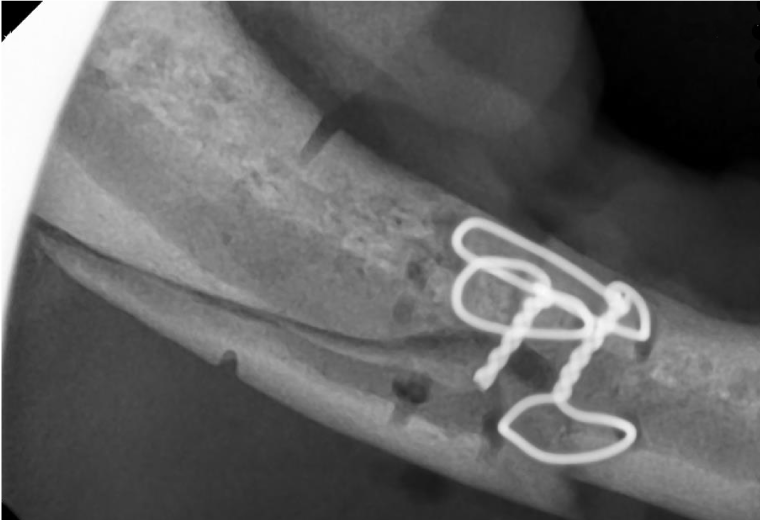 Figure 15: Wire-assisted fracture reduction