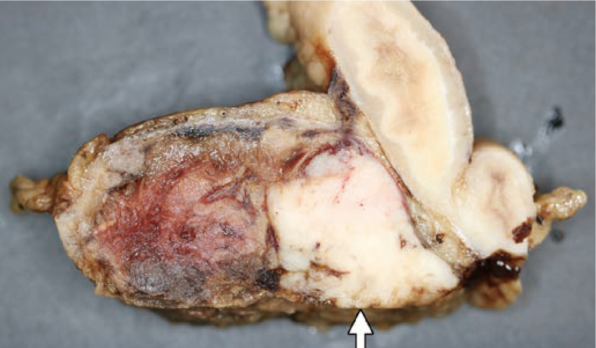 犬の腹腔内悪性腫瘍