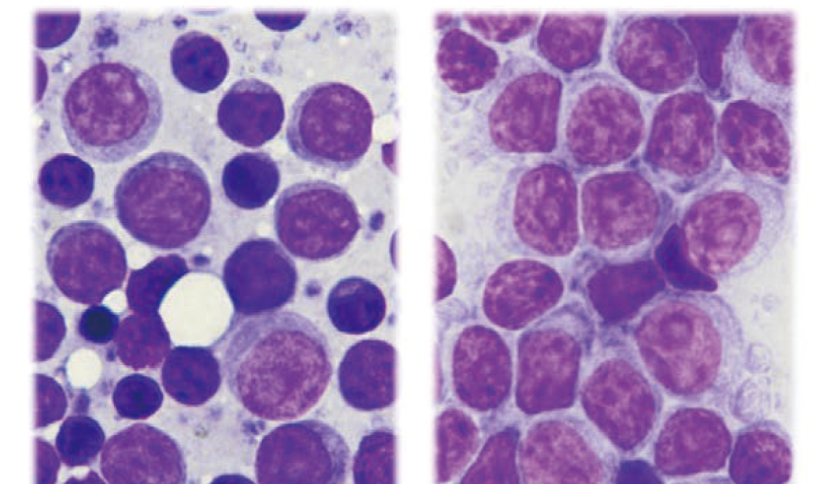 慢性リンパ球性白血病（CLL）と急性リンパ芽球性白血病（ALL）を併発した犬のリンパ節の細胞診所見